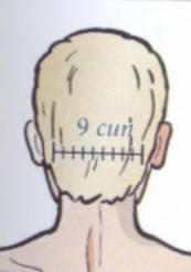 Pontos de acupuntura da parte dorsal do corpo